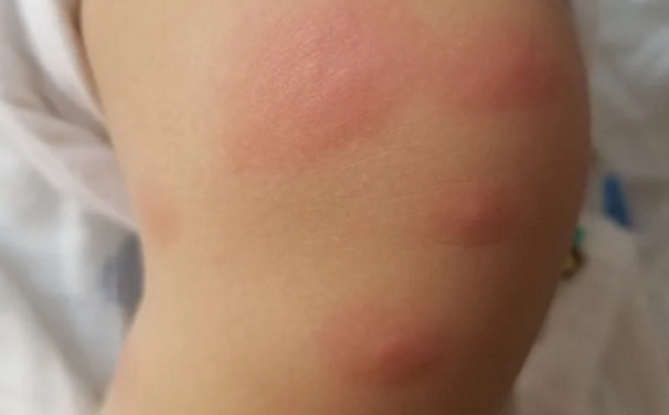 蚊子叮咬腫脹處理