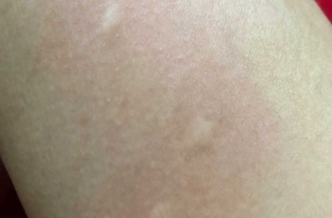 蚊蟲叮咬過敏反應