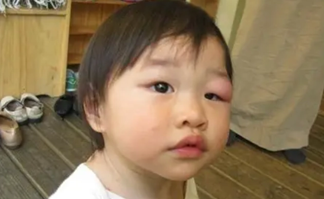 眼皮蚊子叮消腫時間