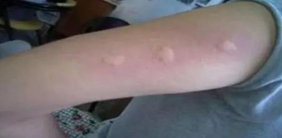 蚊蟲叮咬過敏反應