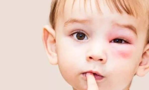 眼皮被咬如何消腫