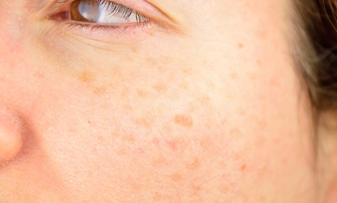 臉上黑斑去除方法