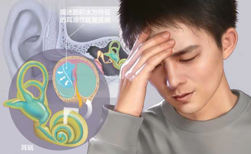 眩暈症多久會好