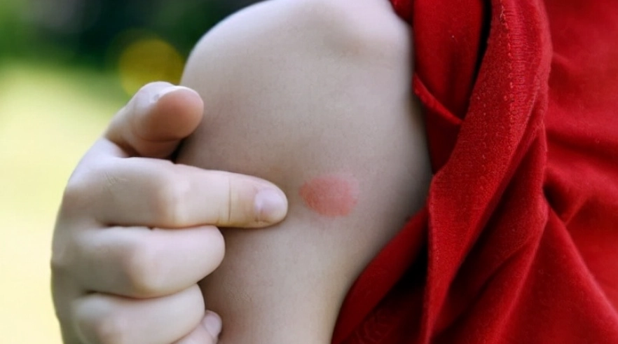 蚊子叮咬消腫技巧