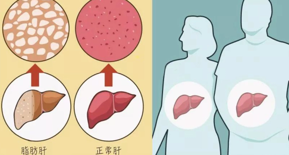 脂肪肝中醫治療