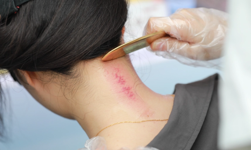 刮痧健康檢測 刮痧健康檢測