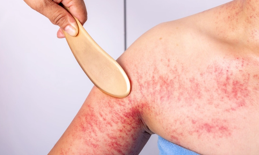 刮痧治療中暑 刮痧治療中暑