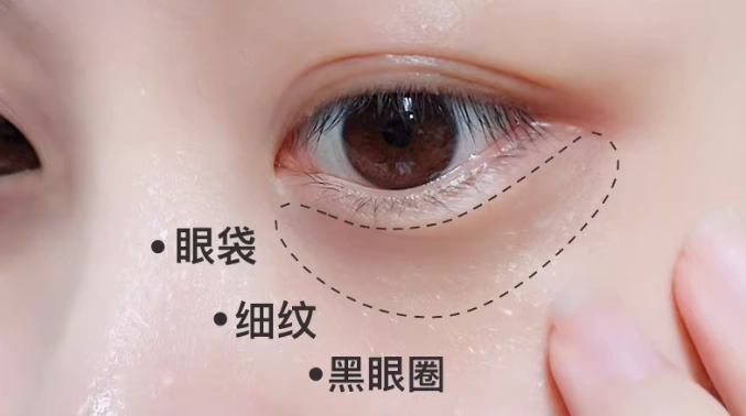 眼袋成因 眼袋成因