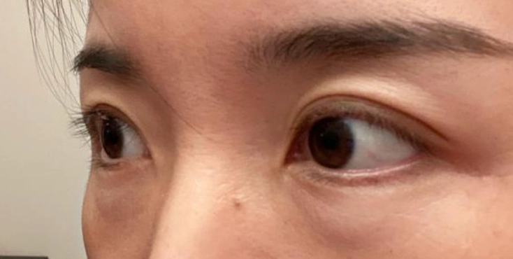 消除眼袋 消除眼袋