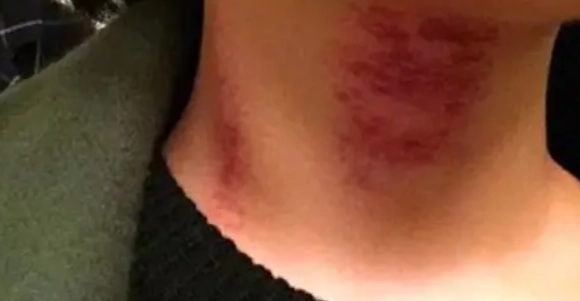 刮痧顏色對照 刮痧顏色對照