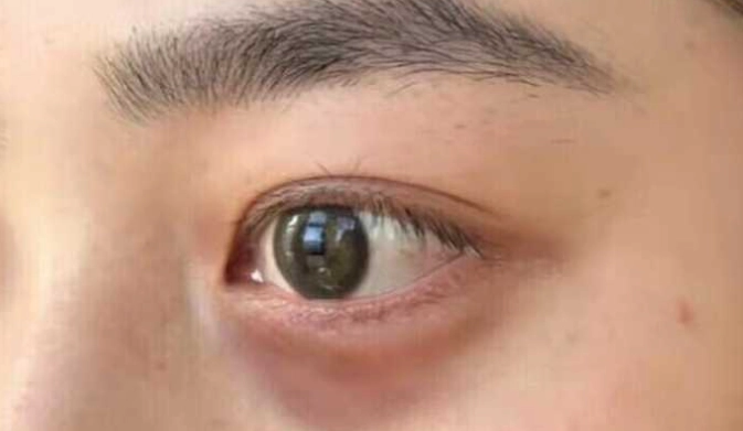 眼袋消除 眼袋消除