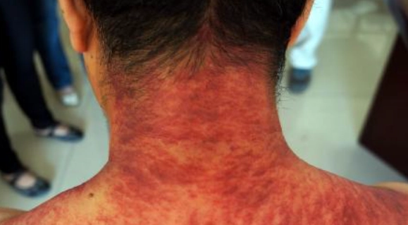 刮痧健康檢測 刮痧健康檢測