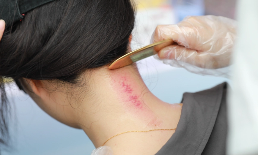 刮痧技巧 刮痧技巧