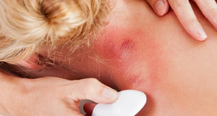 刮痧顏色對照 刮痧顏色對照