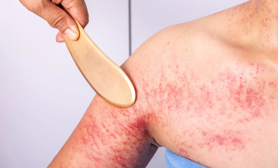 刮痧好處 刮痧好處