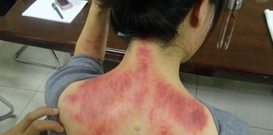 刮痧健康檢測 刮痧健康檢測