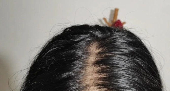 女性掉髮原因 女性掉髮原因