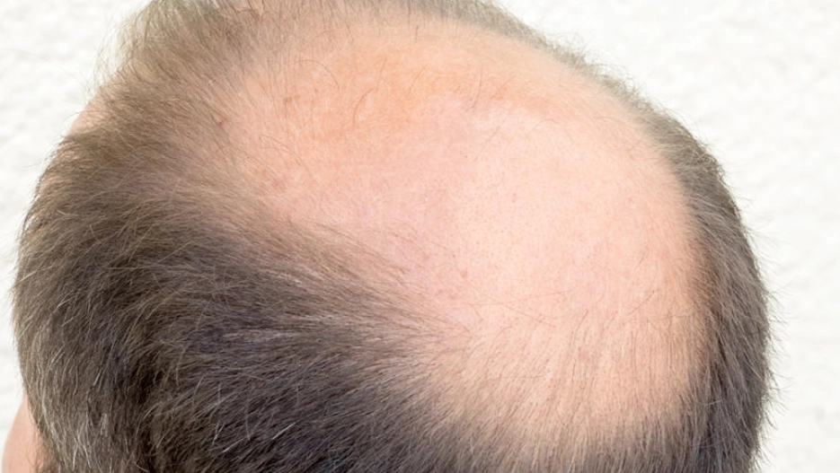 雄性禿 改善 雄性禿 改善