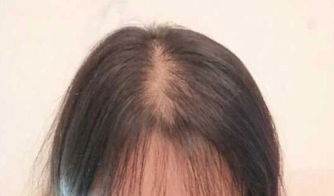 髮量少改善 髮量少改善