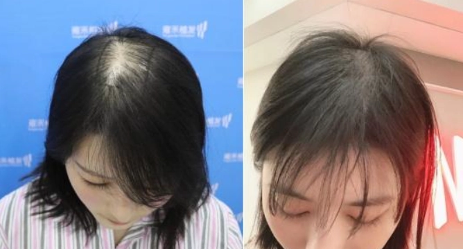 頭皮可見解決 頭皮可見解決