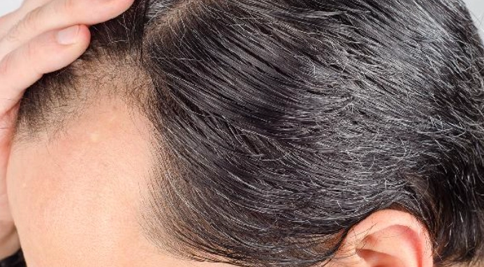 少年白頭髮 少年白頭髮