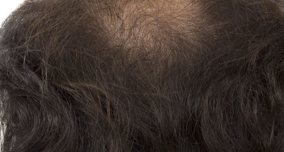 一天長幾根頭髮 一天長幾根頭髮