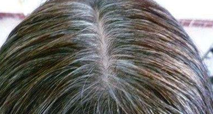 少年白髮原因 少年白髮原因