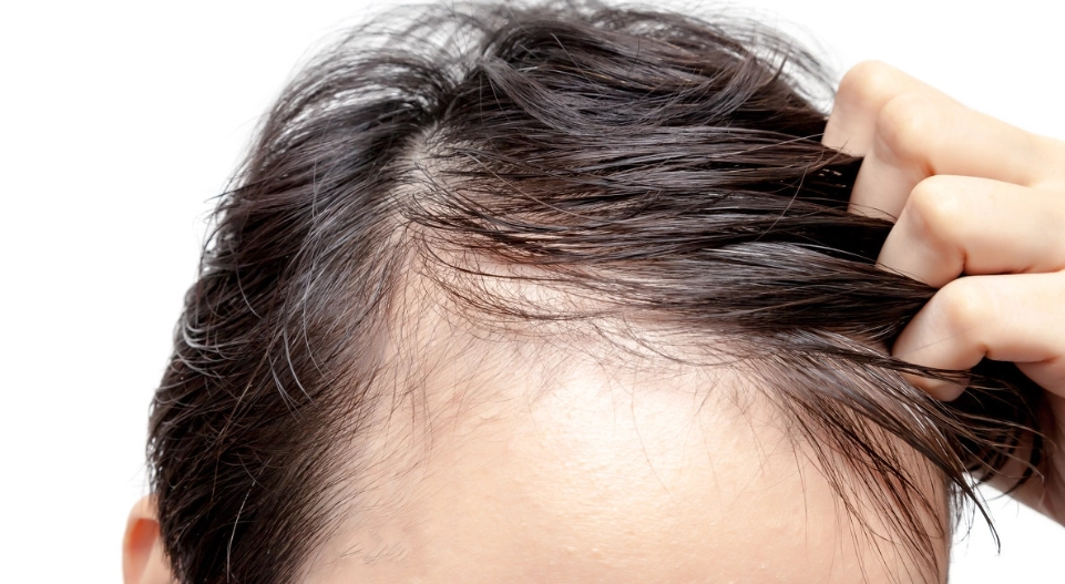 髮量少改善 髮量少改善