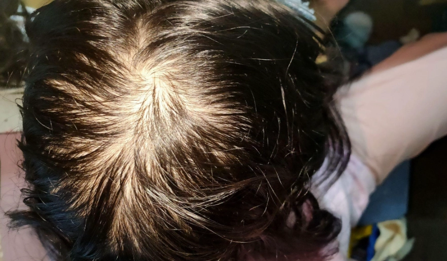 女性掉髮原因 女性掉髮原因