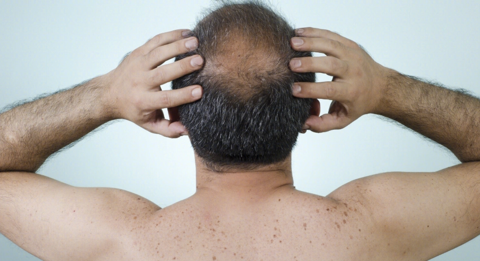 全身毛髮脫落原因 全身毛髮脫落原因