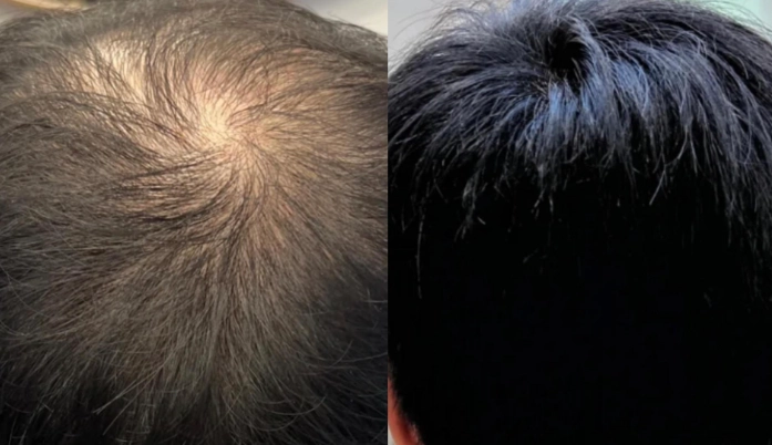 男性髮量稀疏 男性髮量稀疏