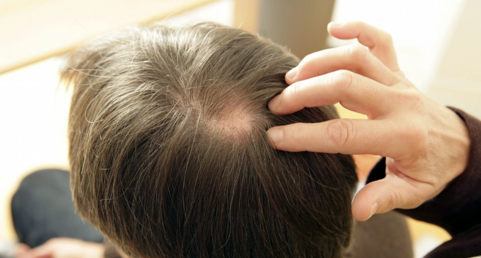 頭髮稀疏看到頭皮 頭髮稀疏看到頭皮