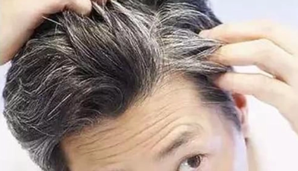 頭髮變白原因 頭髮變白原因